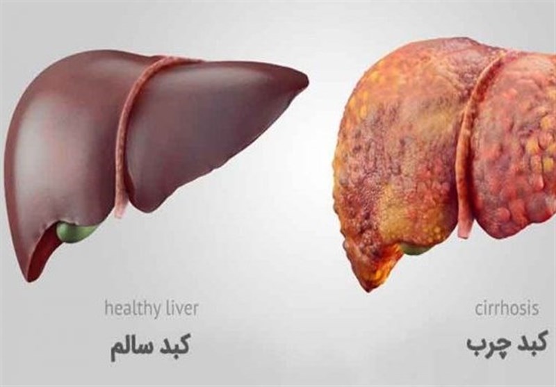 بیماری کبد چرب (Fatty Liver)
